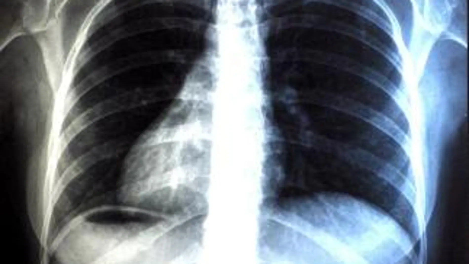 Preparan la primera radiografía del cáncer de pulmón femenino