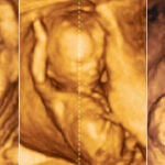 Más del 90% de los fetos con malformación acaba en aborto
