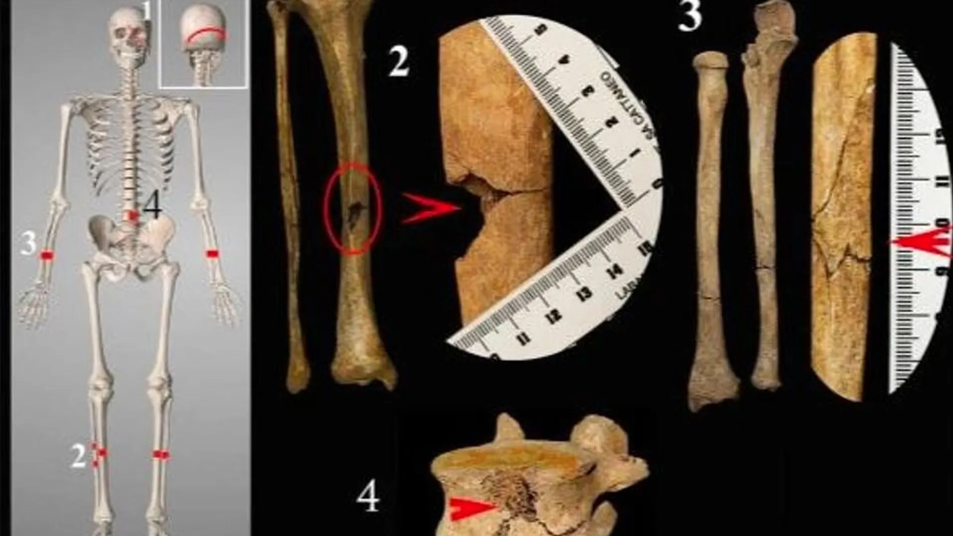 Los huesos del esqueleto muestran los daños causados por la rueda de tortura