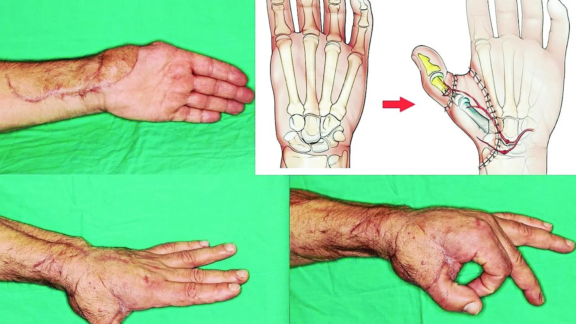 Imágenes del paso a paso de la reconstrucción de la mano