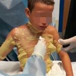 Imagen del menor, que sufrió quemaduras de segundo grado en la cabeza y el torso