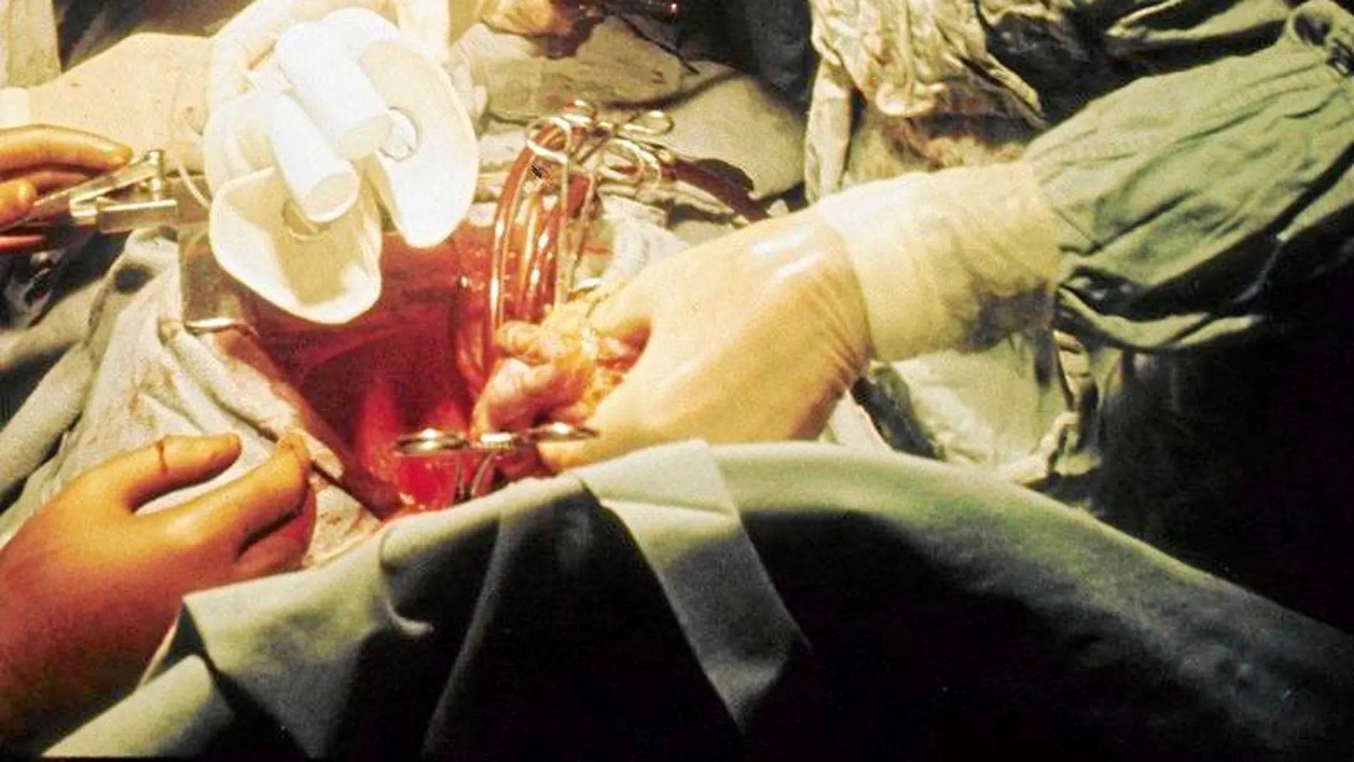 El primer trasplante de corazón artificial realizado en 1969