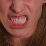El bruxismo se manifiesta clínicamente con hipertrofia y dolor en los músculos masticatorios