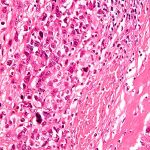 Biopsia que muestra la formación de osteoides en una tinción de osteosarcoma / Wikipedia