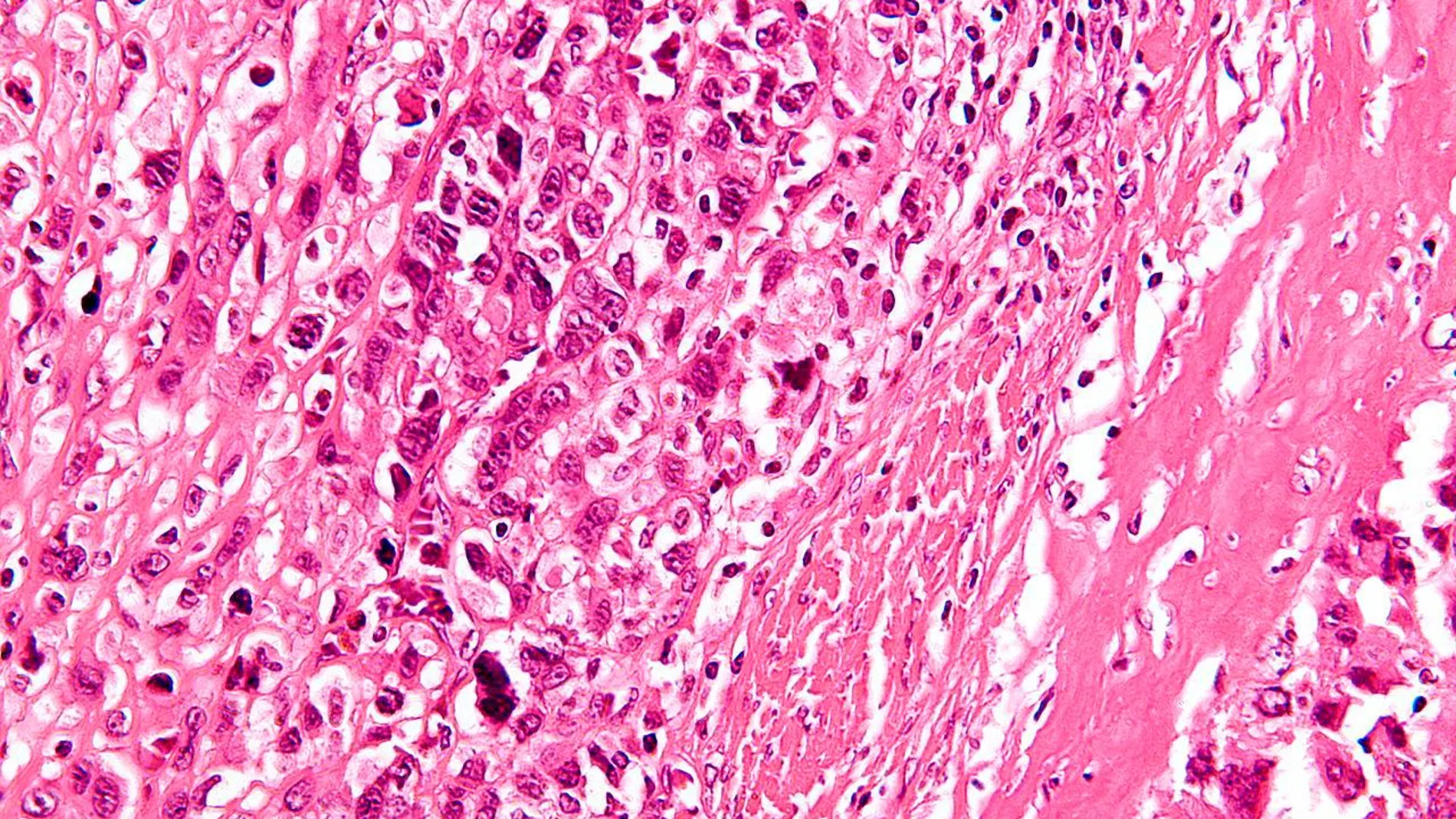 Biopsia que muestra la formación de osteoides en una tinción de osteosarcoma / Wikipedia