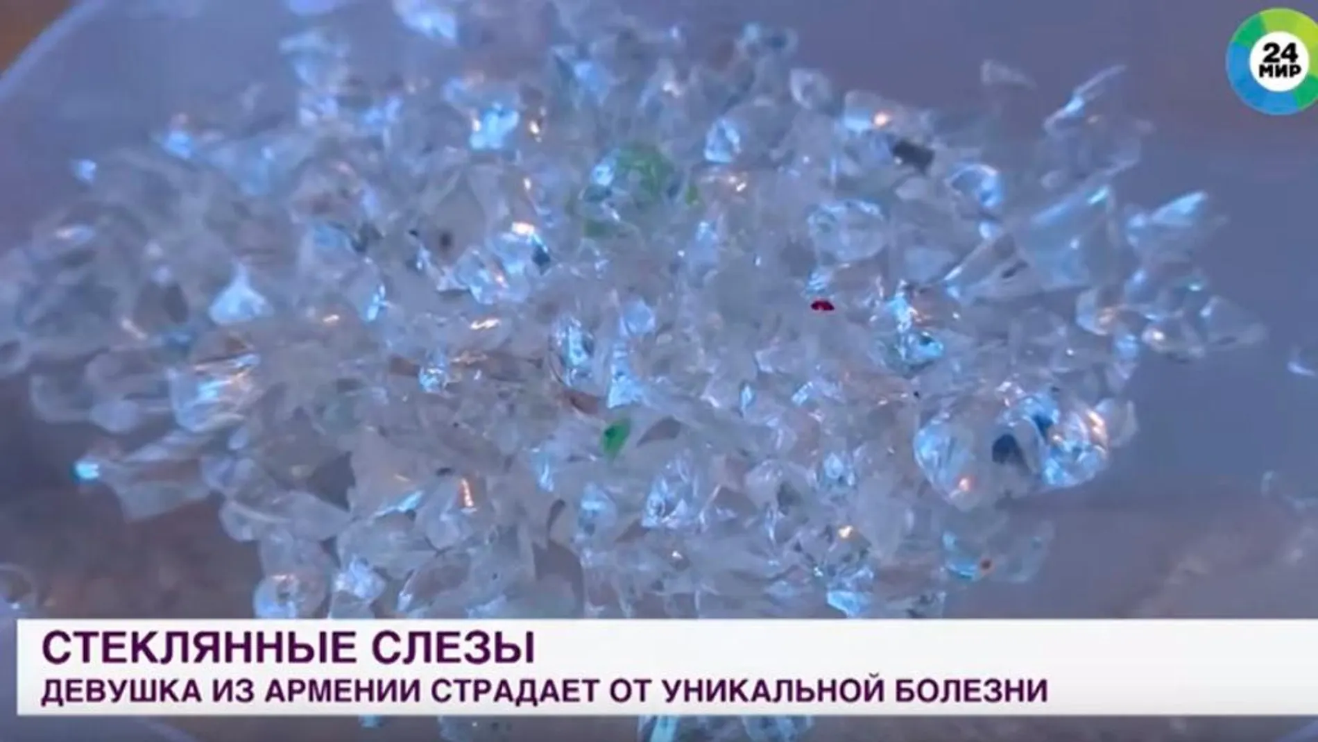 Imagen de los cristales extraídos del ojo de la joven armenia
