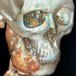Tomografía 3D de la mandíbula del joven. Permite reconocer tridimensionalmente huesos y tejidos.