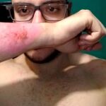 El joven dejó su piel en carne viva/Twitter