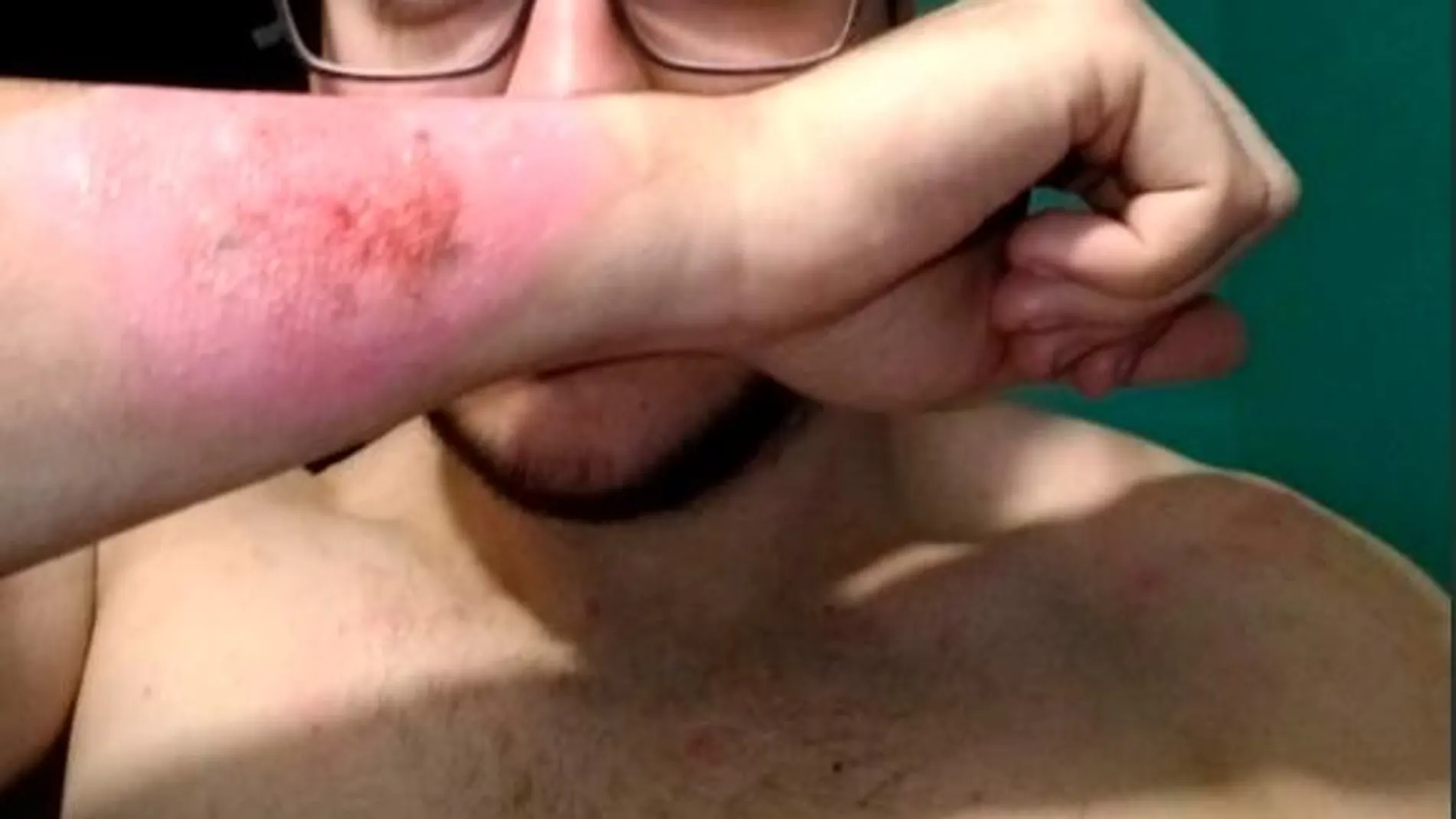 El joven dejó su piel en carne viva/Twitter