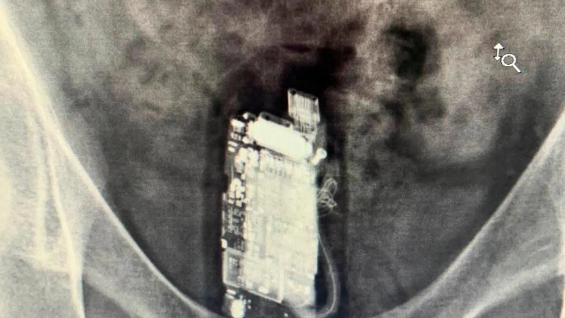 Radiografía del preso en la que localizaron el teléfono