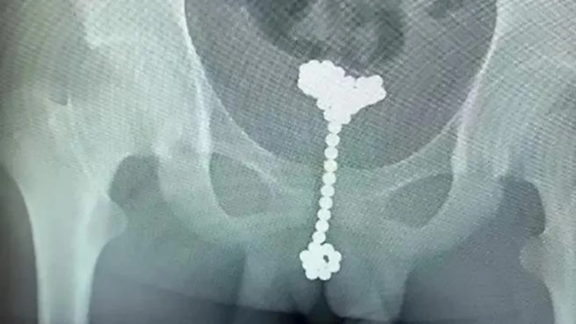 Radiografía del menorcon 31 bolas magnéticas en el pene / Asia Wire - Wuhan Children's Hospital