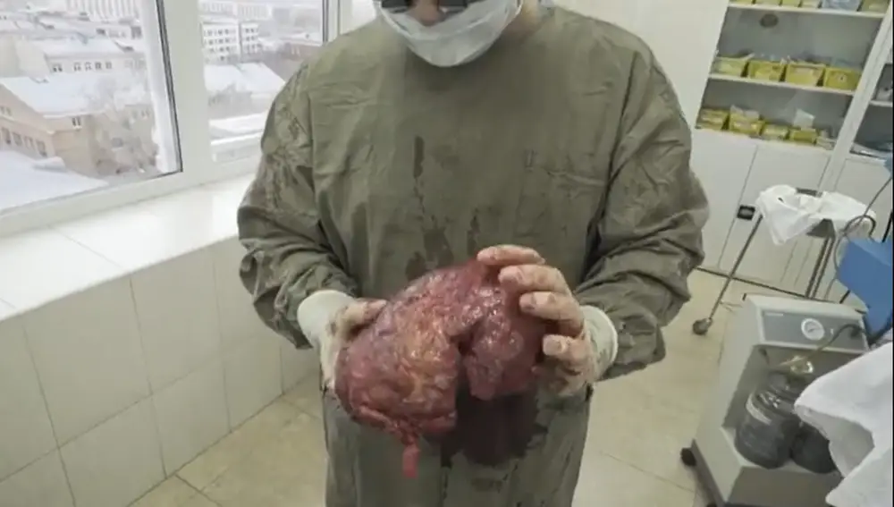 El Dr. Melnikov sostiene la carne muerta extraída del bíceps izquierdo