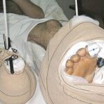 El doctor Cavadas reimplanta el pie a un joven amputado
