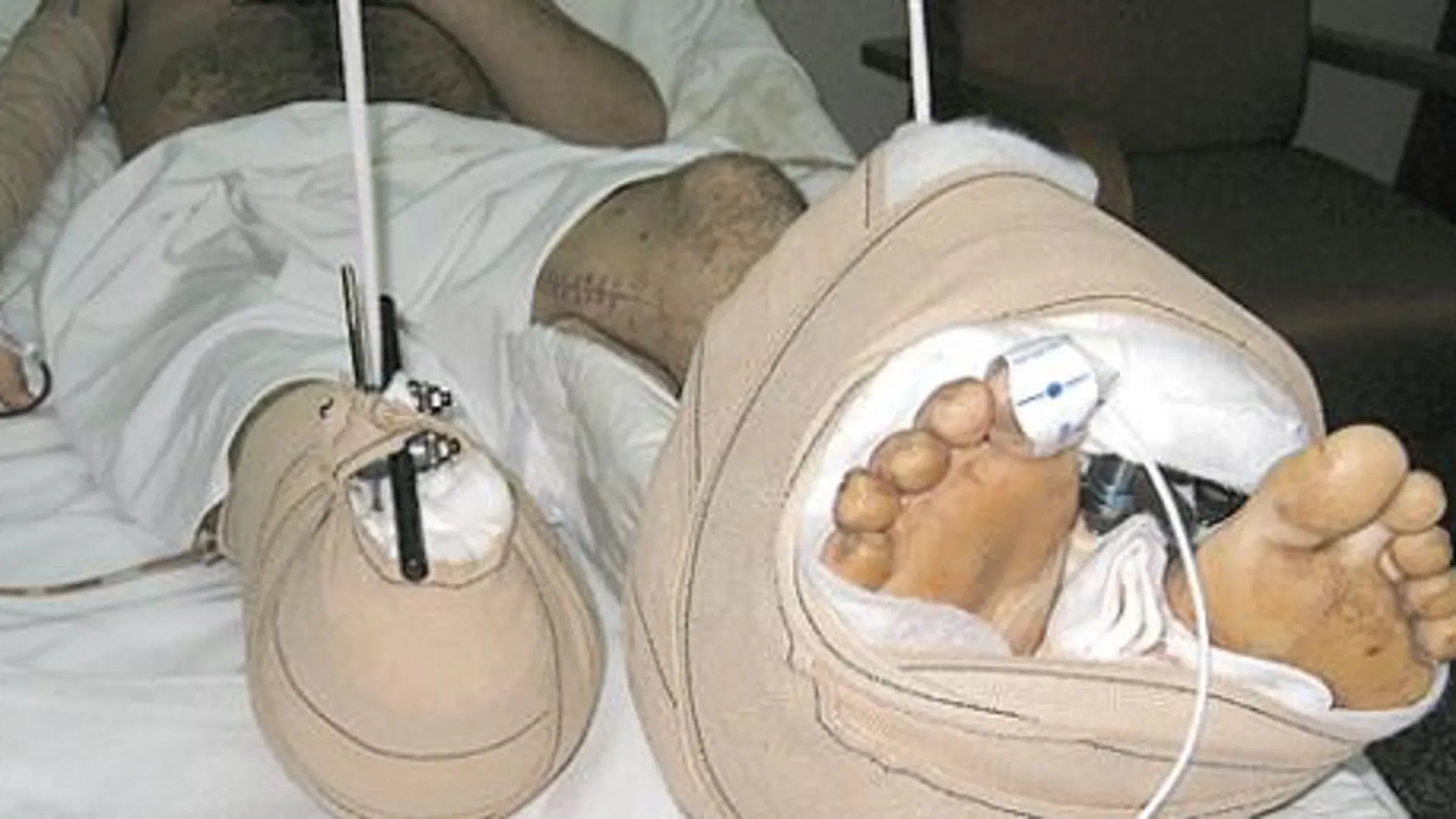El doctor Cavadas reimplanta el pie a un joven amputado