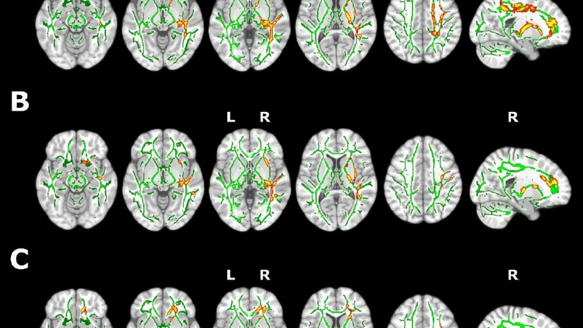 Imagen que muestra el efecto del insomnio en la sustancia blanca cerebral.