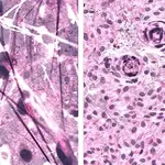 Imágenes histológicas Raman estimuladas de astrocitoma difuso (izquierda) y meningioma (derecha)