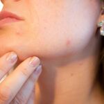 El acné es un problema muy frecuente de la piel que aparece cuando los folículos pilosos debajo de esta se obstruyen