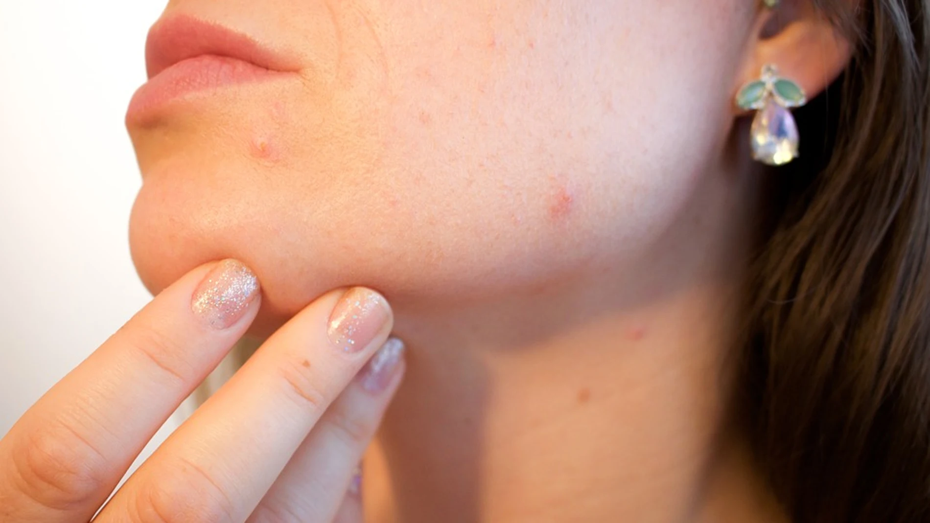 El acné es un problema muy frecuente de la piel que aparece cuando los folículos pilosos debajo de esta se obstruyen
