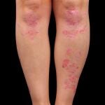 Piernas psoriasis