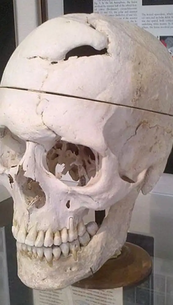 Cráneo de Phineas Gage, expuesto en el Museo Anatómica Warren, en la facultad de Medicina de la Universidad de Harvard.