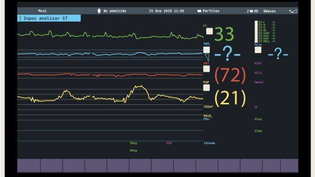 monitor trasplante corazon 2