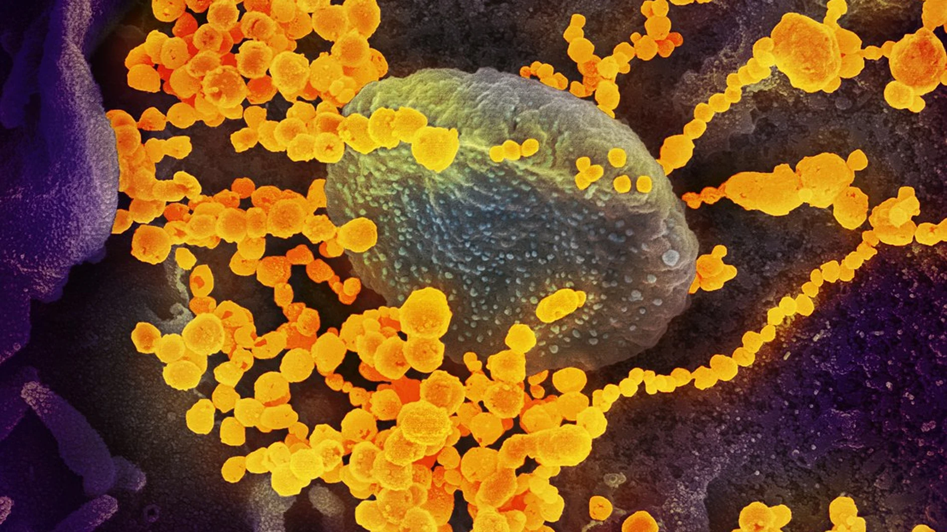 Imagen tomada por un microscopio electrónico de multitud de SARS-CoV-2 (dorado) emergiendo de una célula infectada. (Imagen coloreada artificialmente)