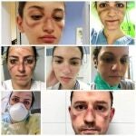 Imágenes de las marcas que las protecciones de seguridad que deberían llevar los sanitarios les dejan en el rostro.