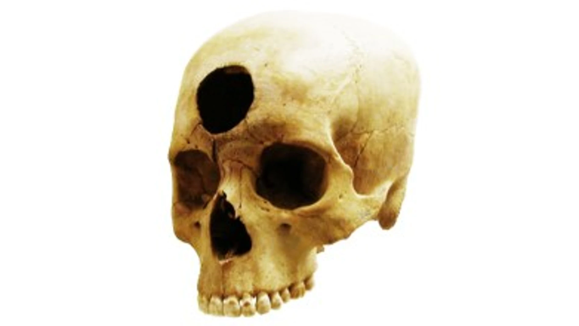 Cráneo trepanado encontrado en Nazca, Perú.