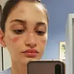 La enfermera italiana Alessia Bonari compartió las marcas que las mascarillas y las gafas dejaron en su piel.