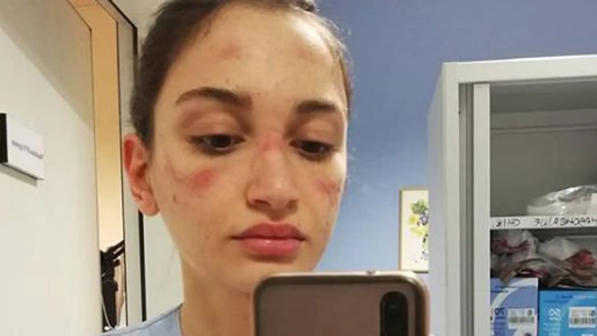 La enfermera italiana Alessia Bonari compartió las marcas que las mascarillas y las gafas dejaron en su piel.