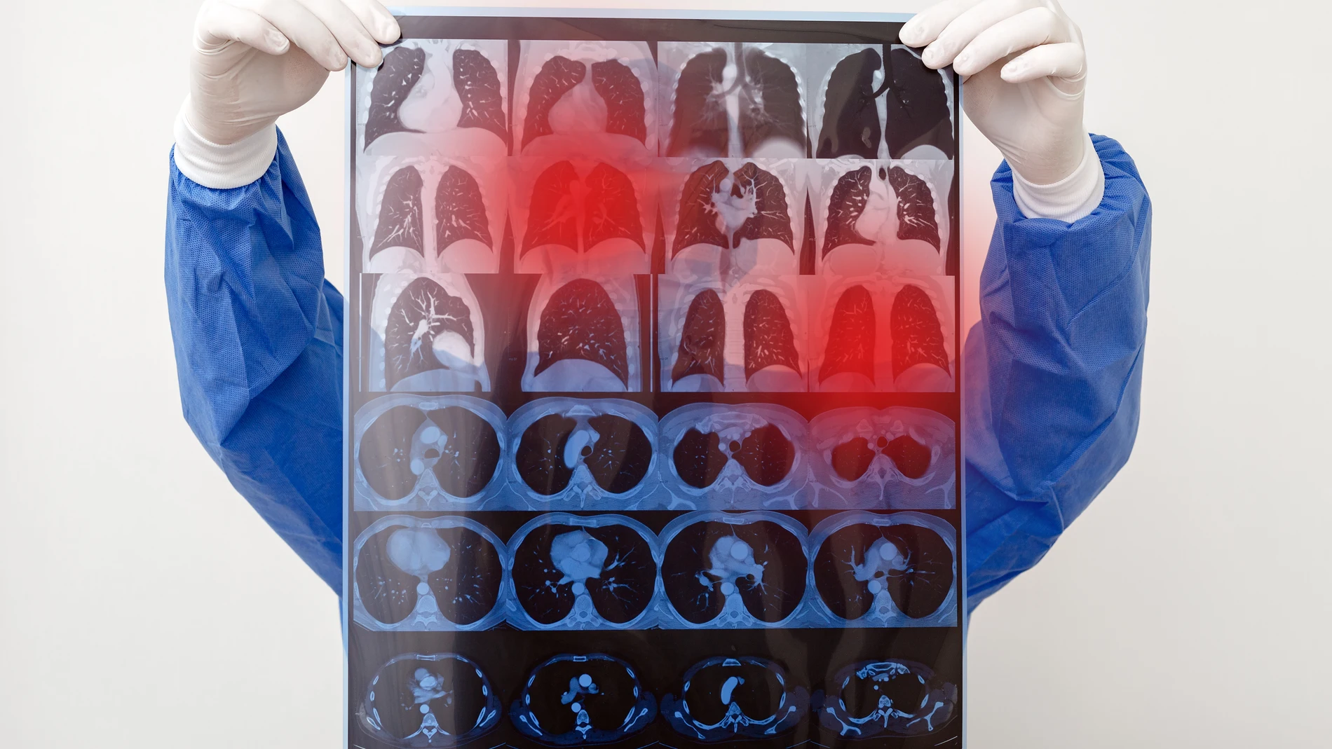 Radiografía con secuelas del coronavirus