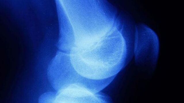 Este tumor óseo maligno se forma en el hueso o en el tejido suave y afecta principalmente a los adolescentes y adultos jóvenes