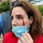 La diputada de Vox Rocío de Meer sangrando de una ceja tras recibir una pedrada en Sestao (Bizkaia)VOX26/06/2020