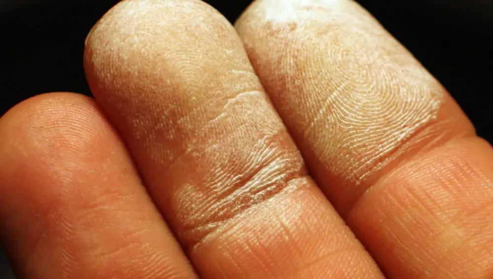 Reacción de agua oxigenada concentrada al 35% con la piel de los dedos, tras un contacto breve.