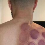 La espalda de Benzema con el cupping