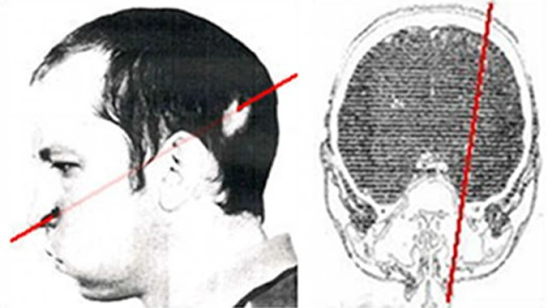 Trayectoria que siguió el haz de partículas al atravesar el cráneo de Busgorski