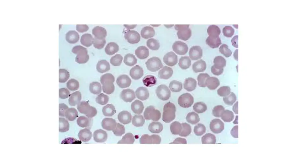 Glóbulos rojos mostrando en el centro uno parasitado con malaria