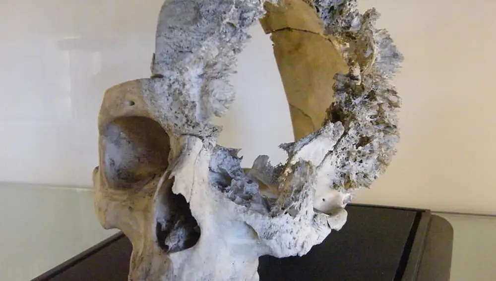 Cráneo humano afectado por un sarcoma expuesto en The Hunterian Museum and Art Gallery