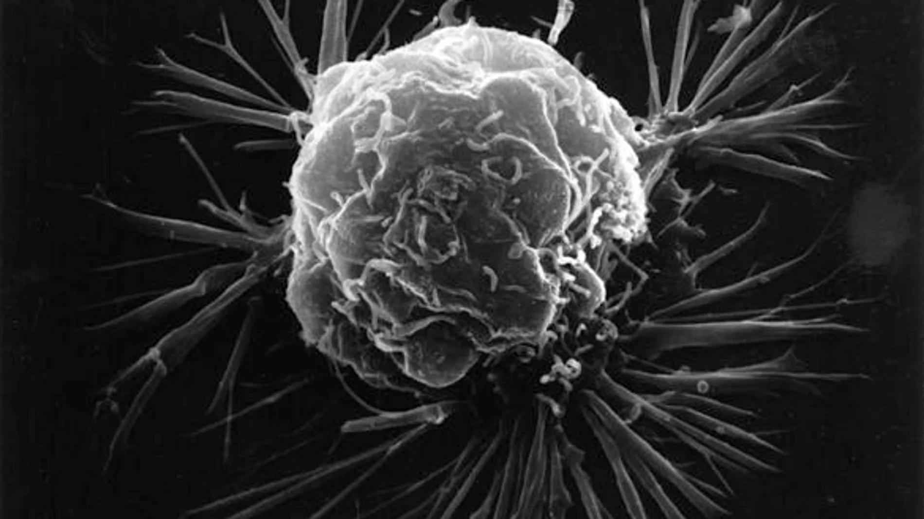Célula de cáncer de mama fotografiada con un microscopio electrónico.