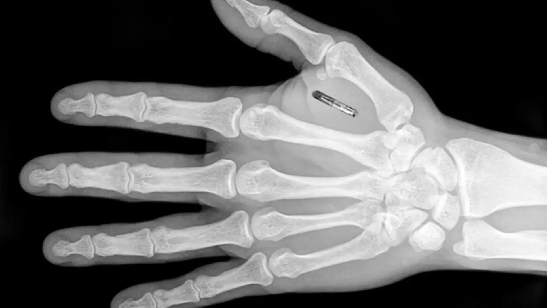 radiografia mano en la que se aprecia implantado un microchips para empresas