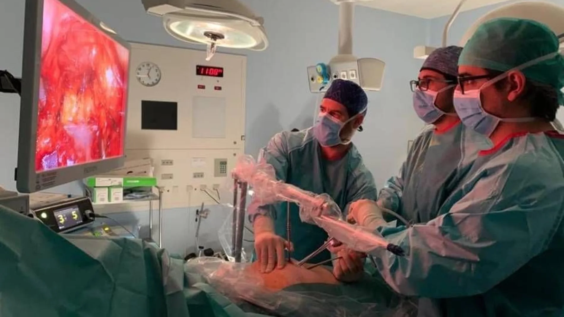 Un equipo de cirujanos del Hospital Quirónsalud Málaga realiza por primera vez en la provincia de Málaga el tratamiento quirúrgico subxifoideo uniportal sobre un nódulo mediastínico