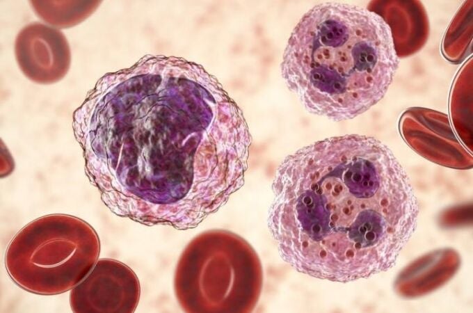 Cambios notables en el número y la proporción entre los diferentes tipos de células sanguíneas es un signo de leucemia