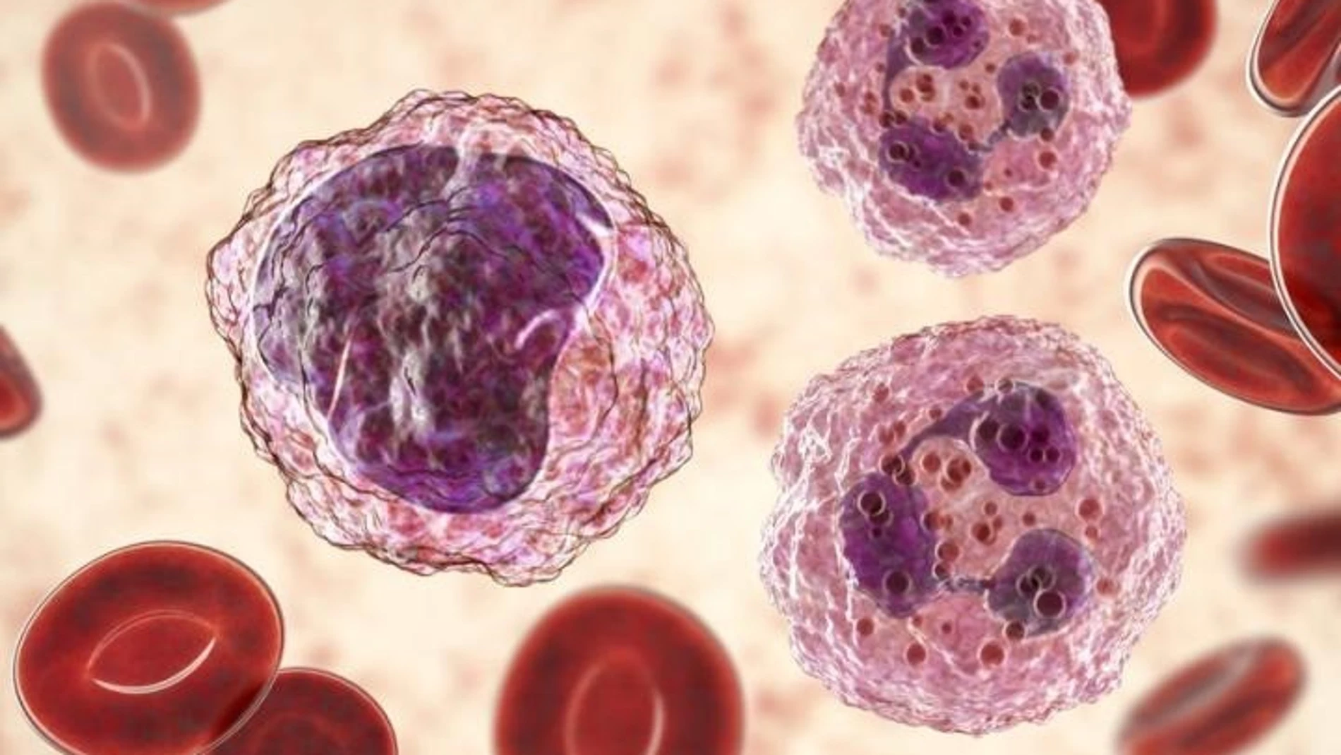 Cambios notables en el número y la proporción entre los diferentes tipos de células sanguíneas es un signo de leucemia
