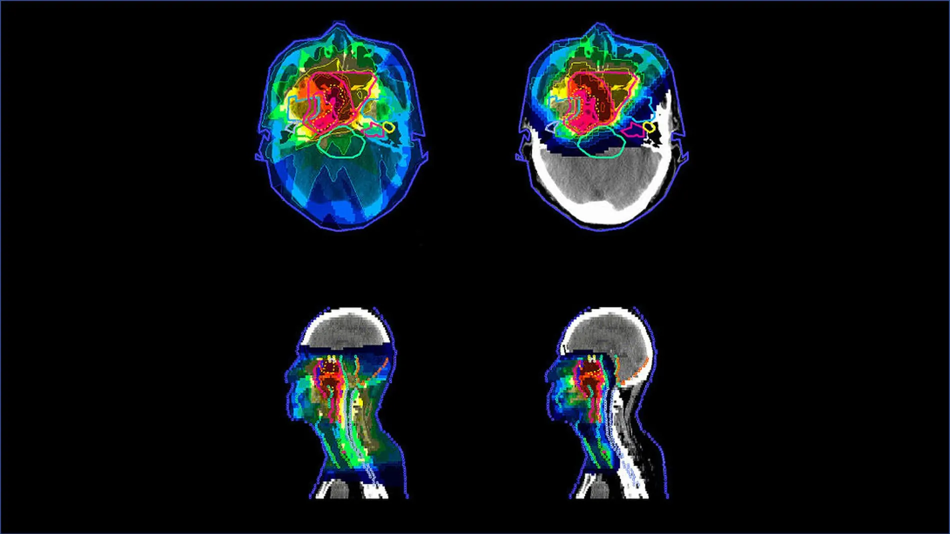 Distribución de la radiación en el cuerpo siendo representando el marrón la mayor intensidad y el azul oscuro la menor. A la izquierda se observa la distribución conseguida con radioterapia de intensidad modulada, a la derecha con protonterapia de intensidad modulada (un tipo de radioterapia.