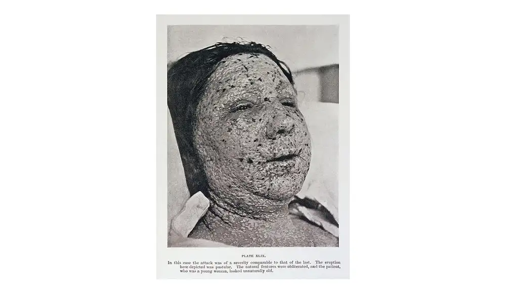 &quot;Diagnóstico de viruela&quot;. Pústulas de viruela en la cara de una mujer fotografiada en 1908.
