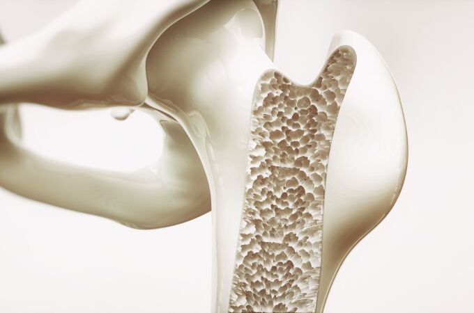 La osteoporosis es una condición de salud que debilita los huesos, haciéndolos frágiles y más propensos a romperse | Fuente: Dreamstime