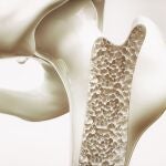 La osteoporosis es una condición de salud que debilita los huesos, haciéndolos frágiles y más propensos a romperse | Fuente: Dreamstime