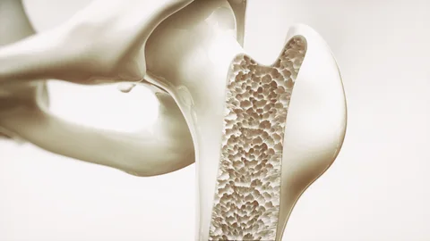 La osteoporosis es una condición de salud que debilita los huesos, haciéndolos frágiles y más propensos a romperse | Fuente: Dreamstime