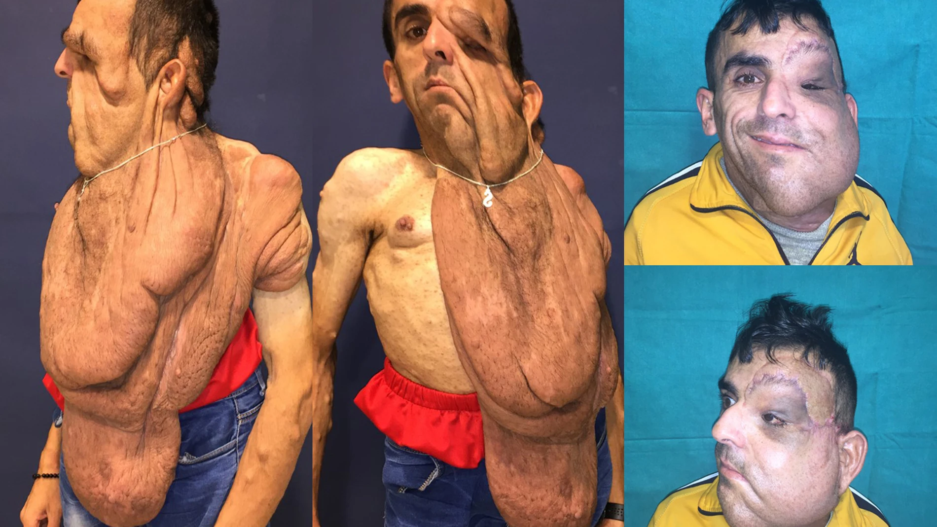 Imágenes de Ali Amnad Rafi antes y después de ser sometido a las intervenciones para extirparle el tumoración gigante de la cara, que le llegaba por debajo de la cintura