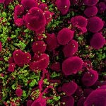 Micrografía electrónica de barrido coloreada de una célula apoptótica (rosa) muy infectada con partículas del virus SARS-COV-2 (verde), aislada de una muestra de un paciente